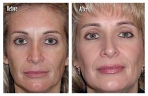MicrodermabrasionBeforeAndAfter