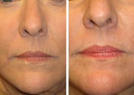 mircodermabrasion lips